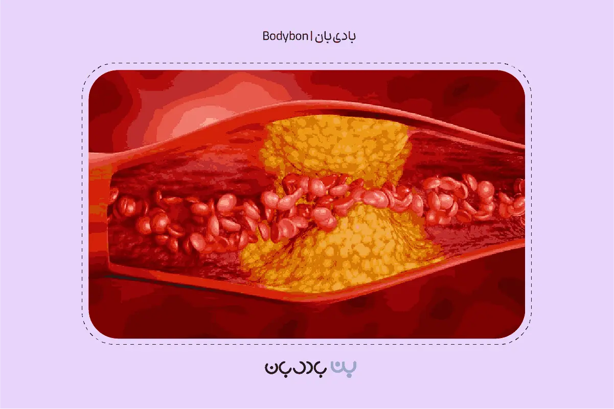 رسوب کلسترول بد در جداره سرخرگ‌ها و خطر بیماری قلبی عروقی در جواب آزمایش چربی خون