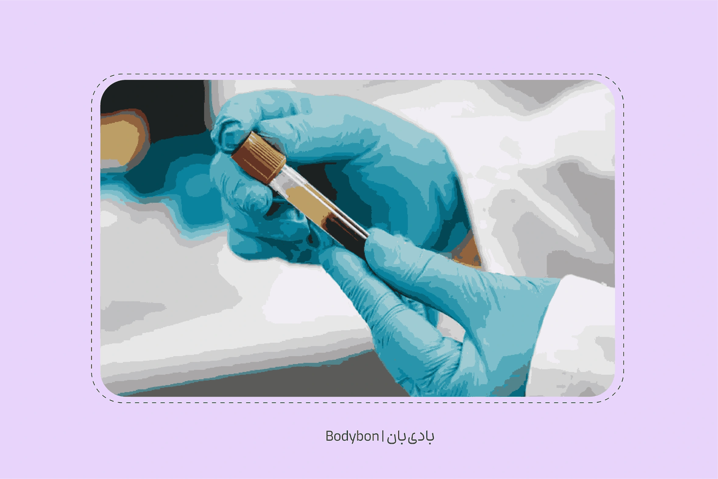 علائم سرطان پانکراس در آزمایش خون چیست؟ 1 آزمایش آمیلاز و لیپاز به تشخیص علائم سرطان پانکراس در آزمایش خون کمک میکند.