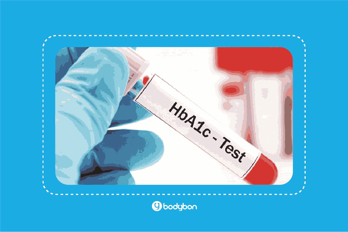 آزمایش HbA1C چیست؟ تفسیر HbA1C در آزمایش خون 1 نمونه HbA1C در آزمایش خون در آزمایش خون چگونه گرفته میشود؟